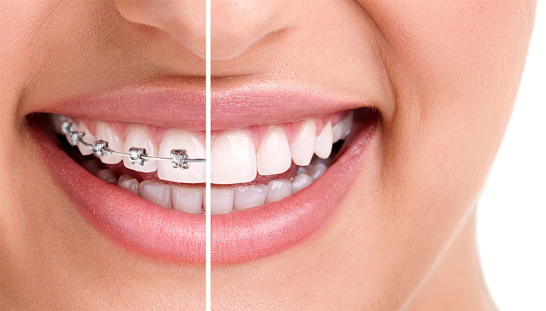 ortodoncia-clinica-dental-lazaro